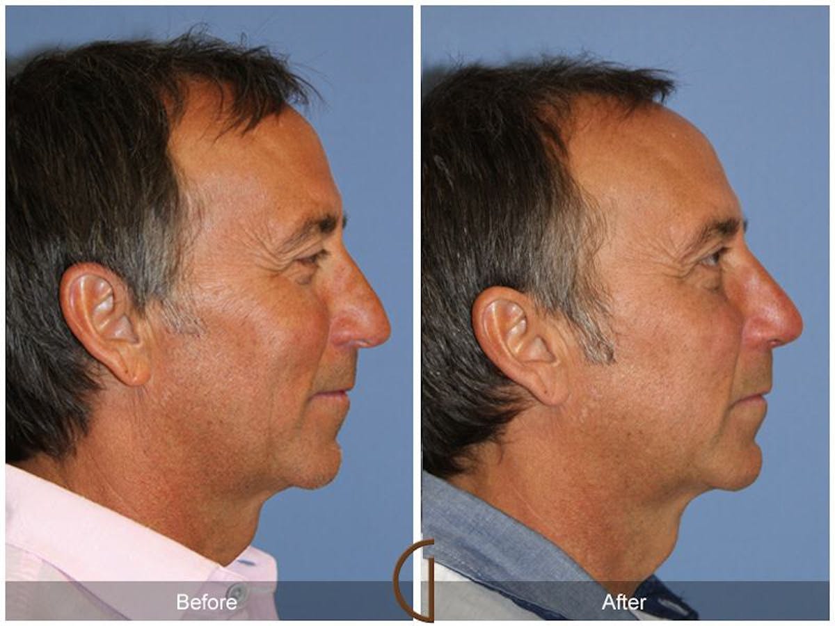 Rhinoplasty Before & After Gallery - Patient 739157 - Image 3