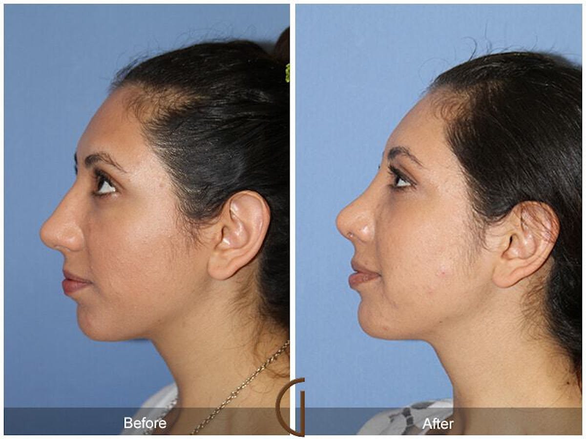 Female Rhinoplasty Before & After Gallery - Patient 234514 - Image 1