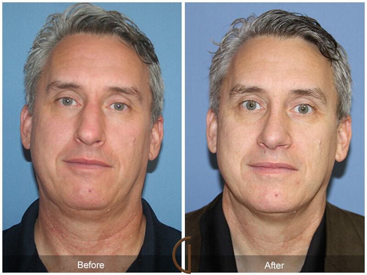 Rhinoplasty Before & After Gallery - Patient 329179 - Image 2