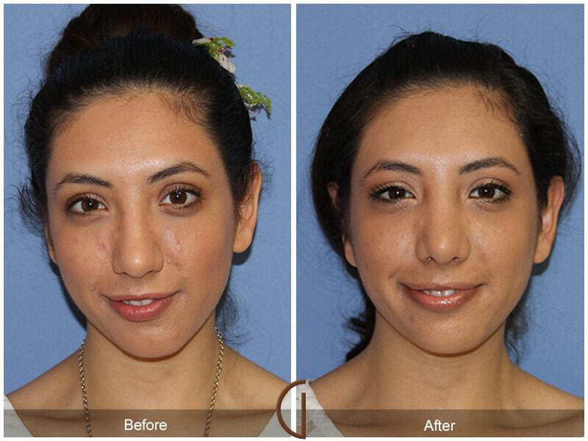 Female Rhinoplasty Before & After Gallery - Patient 234514 - Image 2