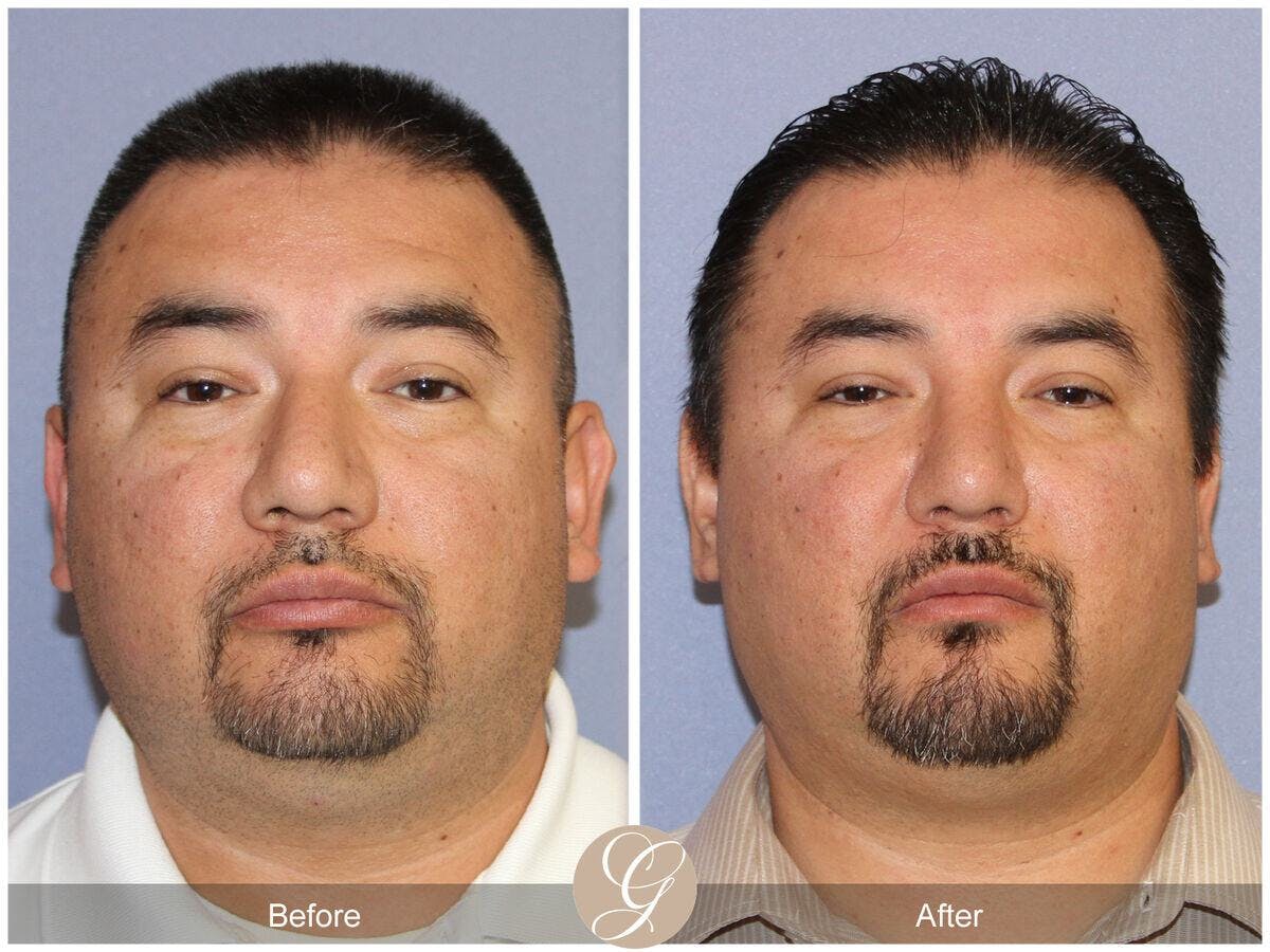 Male Rhinoplasty Before & After Gallery - Patient 215273 - Image 2