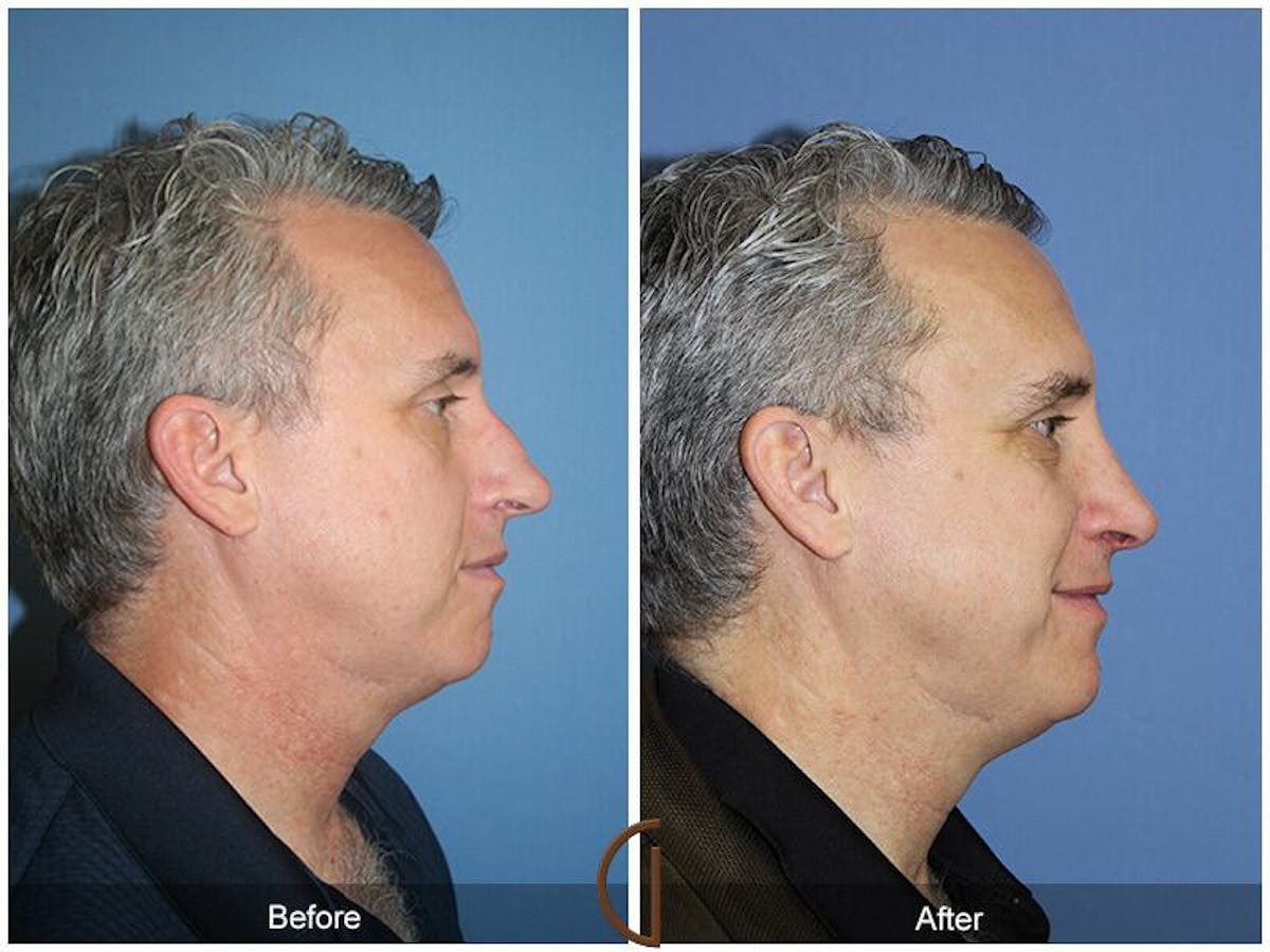 Rhinoplasty Before & After Gallery - Patient 329179 - Image 3