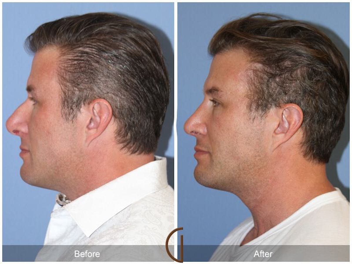 Male Rhinoplasty Before & After Gallery - Patient 364879 - Image 1