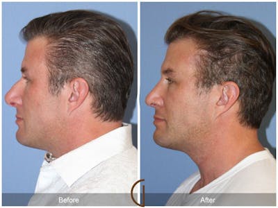 Male Rhinoplasty Before & After Gallery - Patient 364879 - Image 1