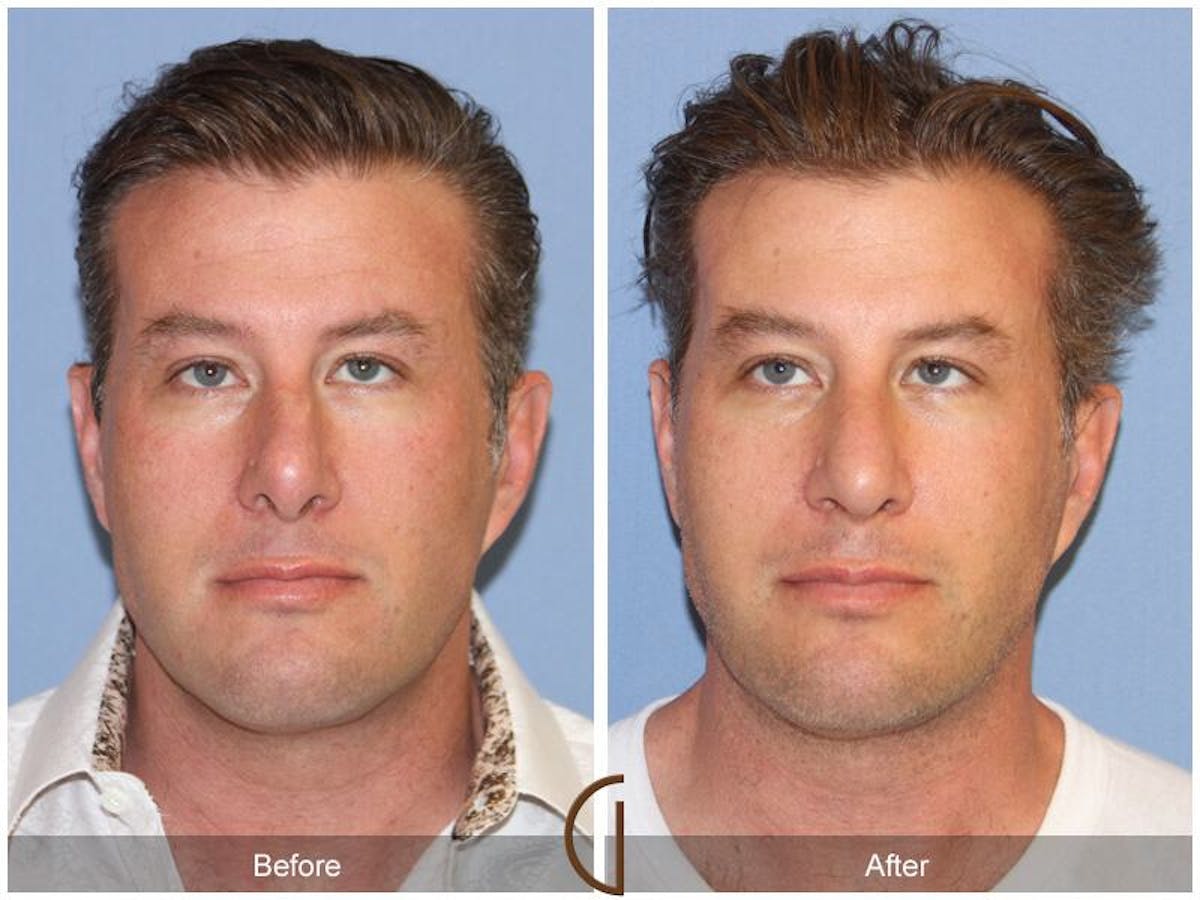 Male Rhinoplasty Before & After Gallery - Patient 364879 - Image 2