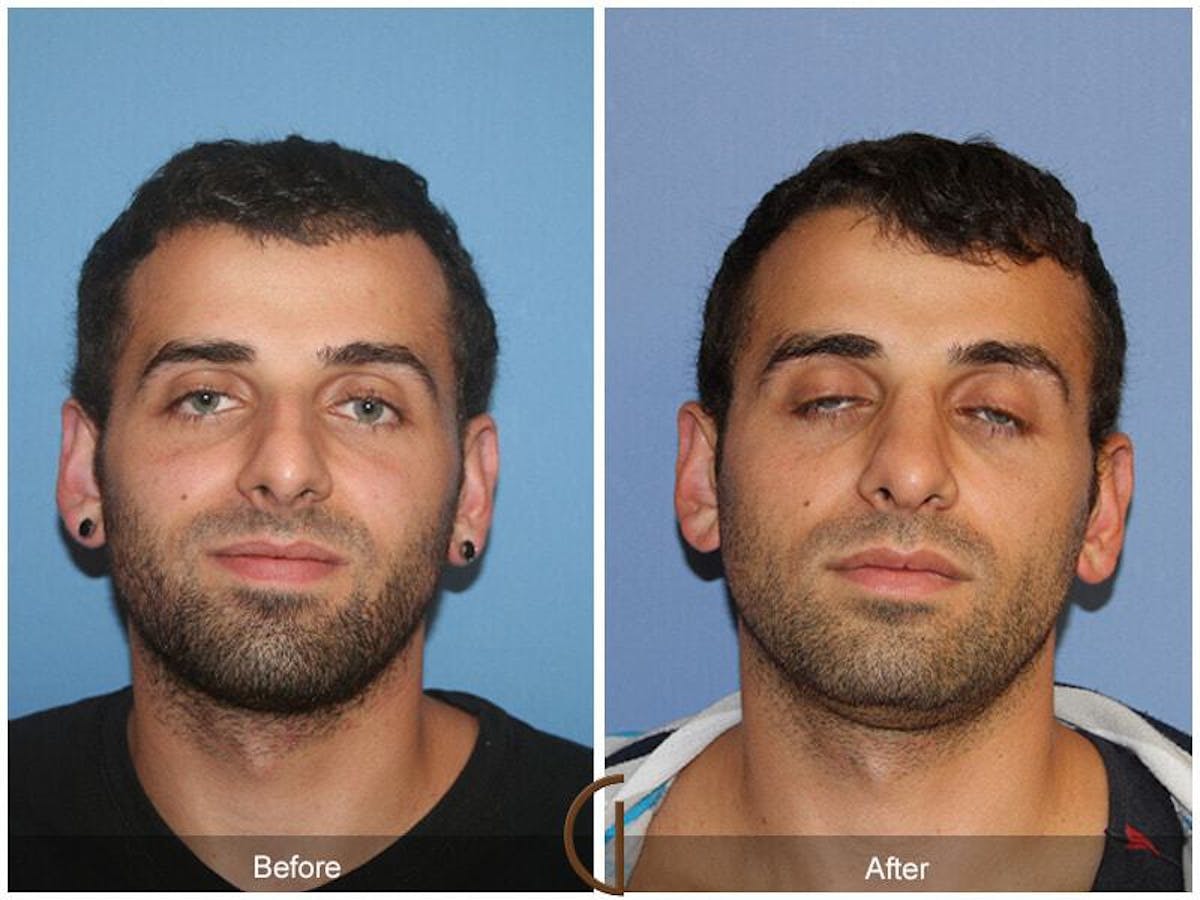 Ethnic Rhinoplasty Before & After Gallery - Patient 293485 - Image 2