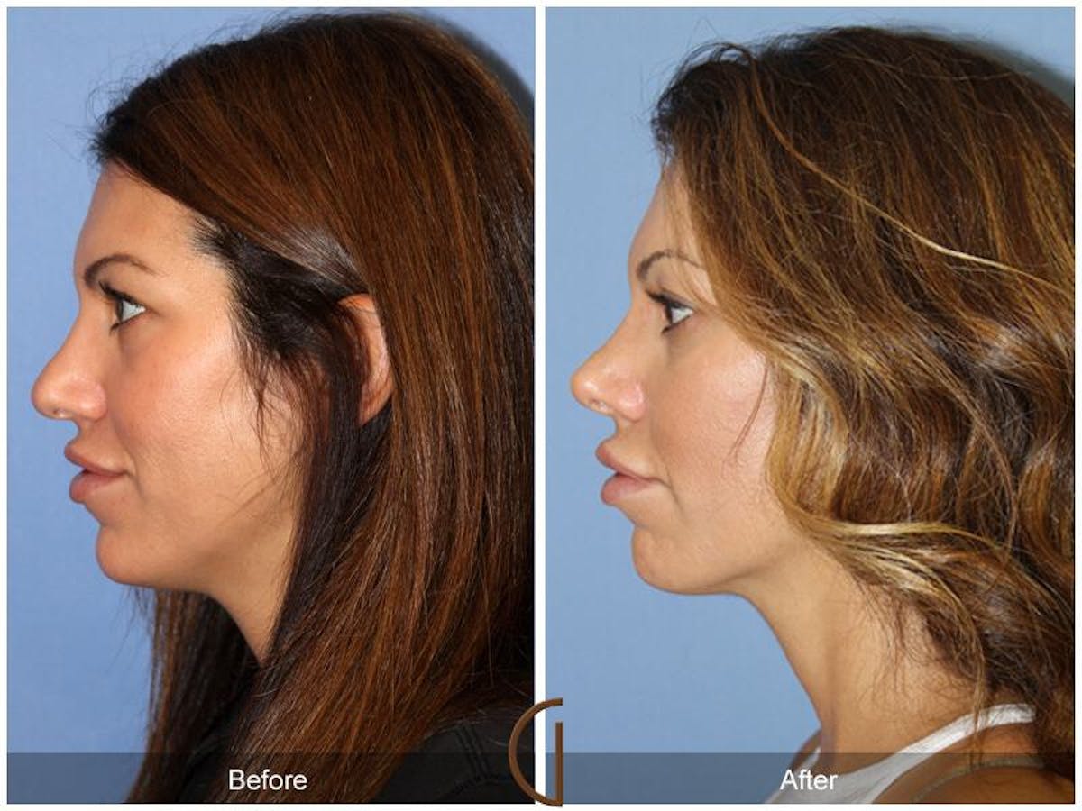 Female Rhinoplasty Before & After Gallery - Patient 329801 - Image 1