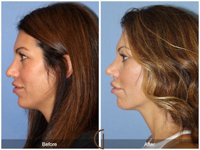 Female Rhinoplasty Before & After Gallery - Patient 329801 - Image 1