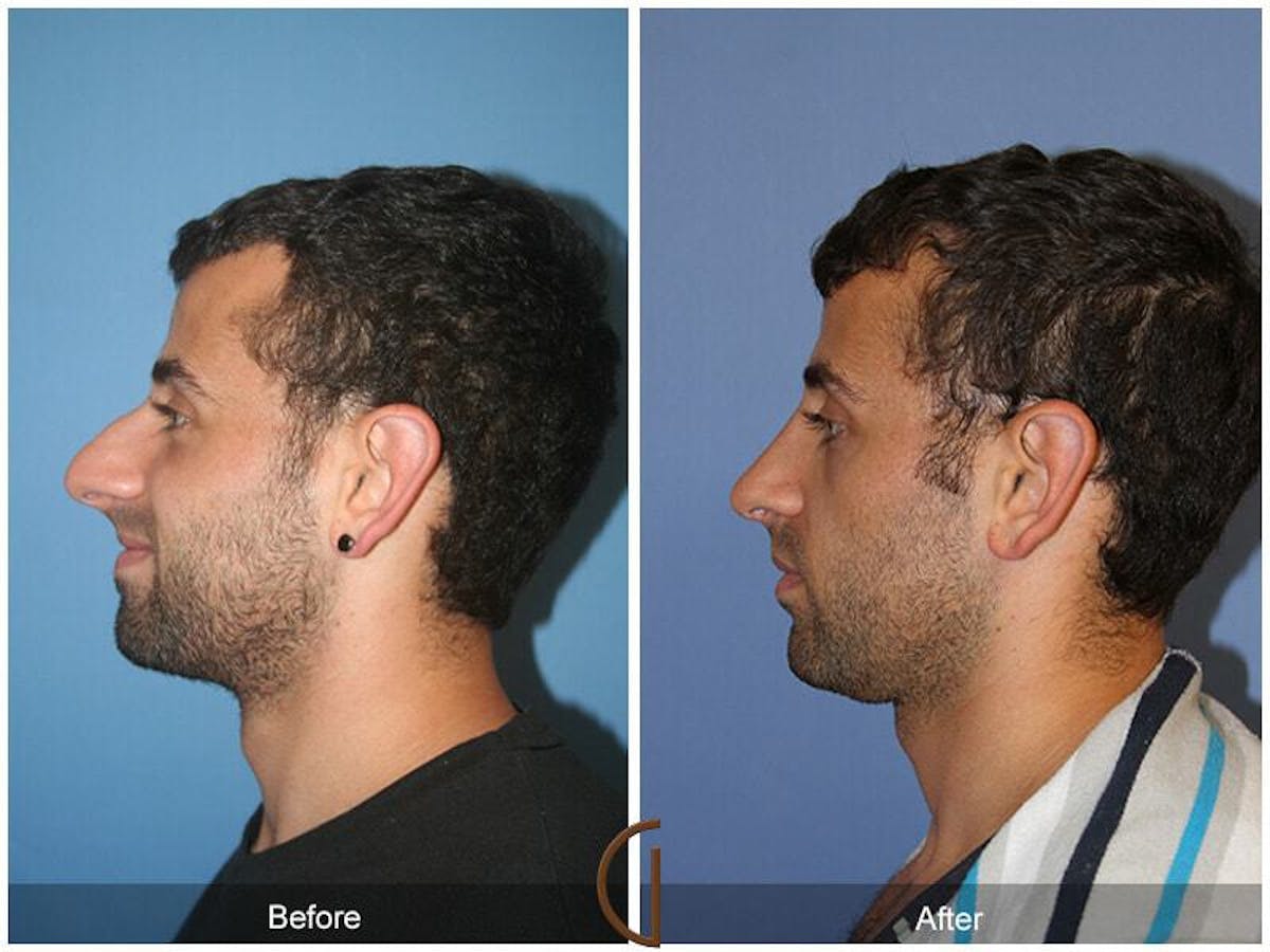 Ethnic Rhinoplasty Before & After Gallery - Patient 293485 - Image 1