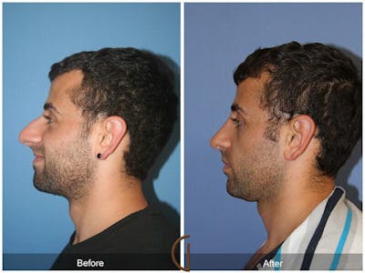 Male Rhinoplasty Before & After Gallery - Patient 118275 - Image 1