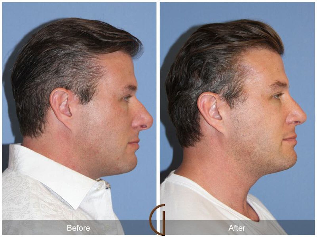 Male Rhinoplasty Before & After Gallery - Patient 364879 - Image 3