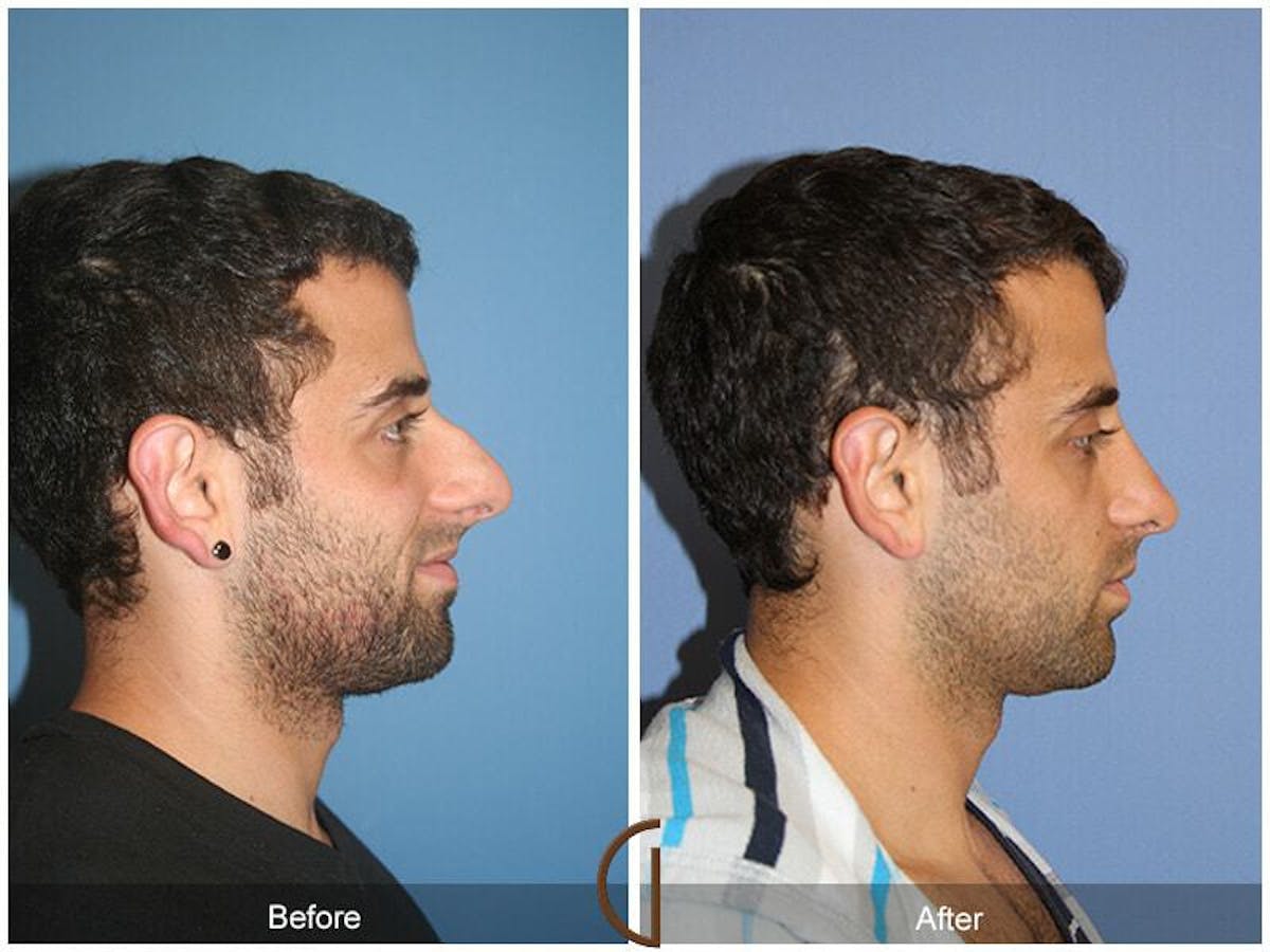 Ethnic Rhinoplasty Before & After Gallery - Patient 293485 - Image 3