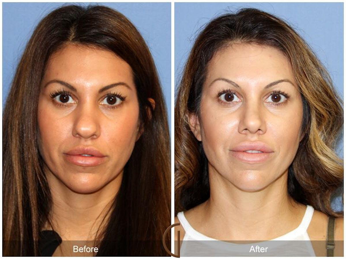 Female Rhinoplasty Before & After Gallery - Patient 329801 - Image 2