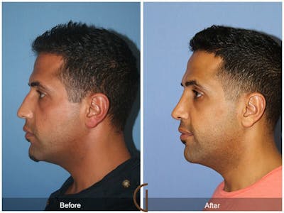 Rhinoplasty Before & After Gallery - Patient 131329 - Image 1