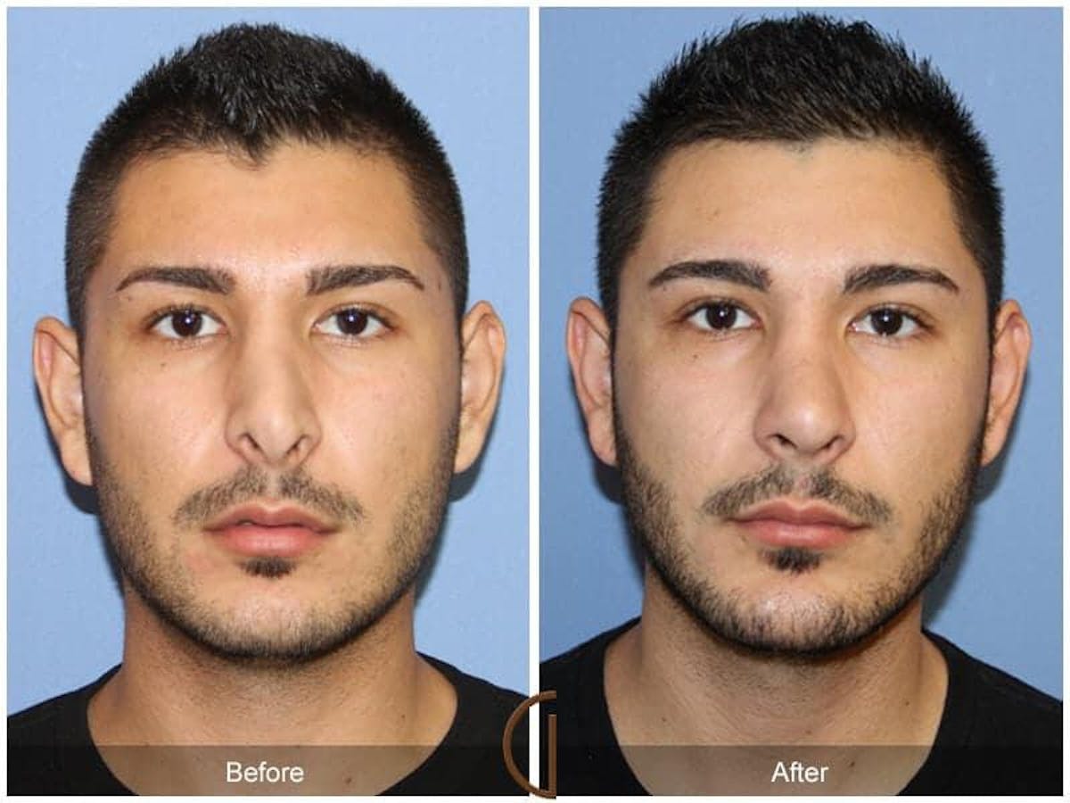 Revision Rhinoplasty Before & After Gallery - Patient 260905 - Image 2