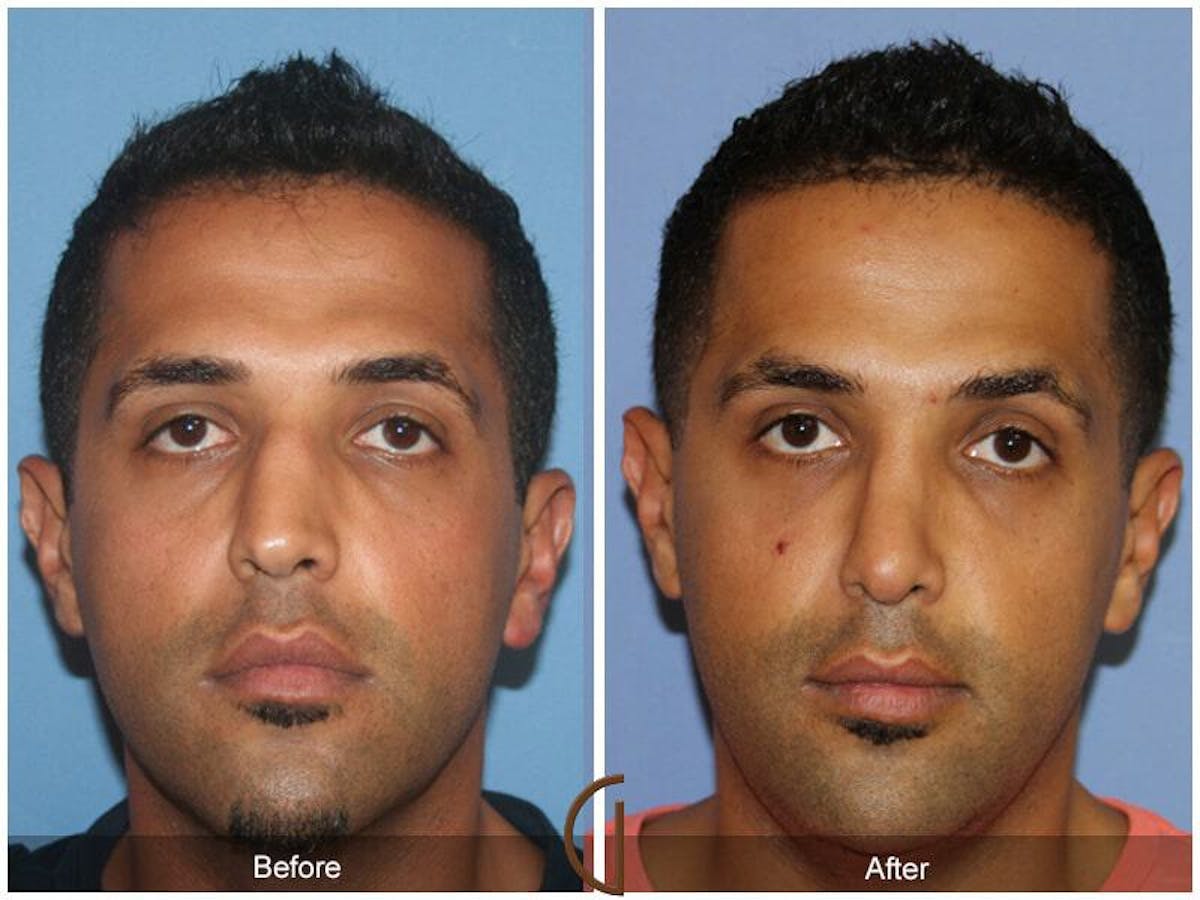 Ethnic Rhinoplasty Before & After Gallery - Patient 153017 - Image 2