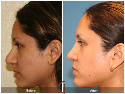 Revision Rhinoplasty Before & After Gallery - Patient 360228 - Image 1