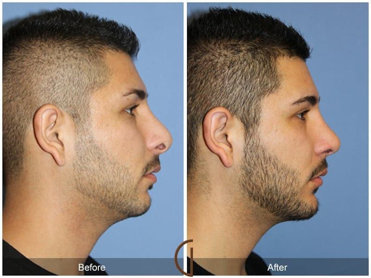 Revision Rhinoplasty Before & After Gallery - Patient 260905 - Image 3