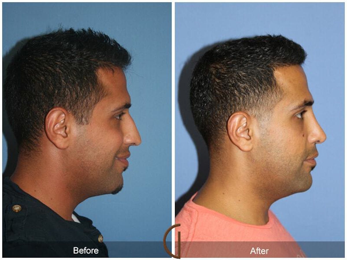 Ethnic Rhinoplasty Before & After Gallery - Patient 153017 - Image 3