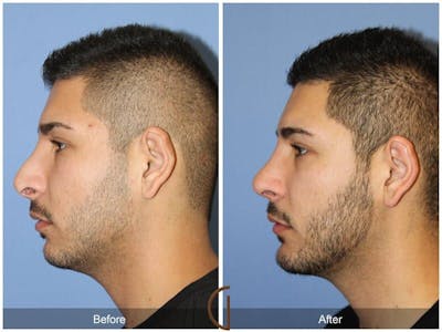 Revision Rhinoplasty Before & After Gallery - Patient 260905 - Image 1