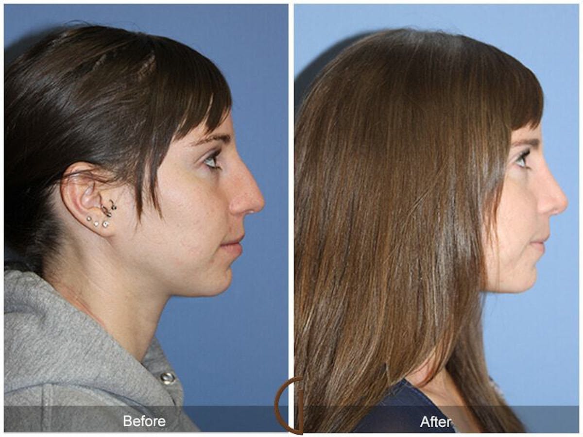 Female Rhinoplasty Before & After Gallery - Patient 268839 - Image 3