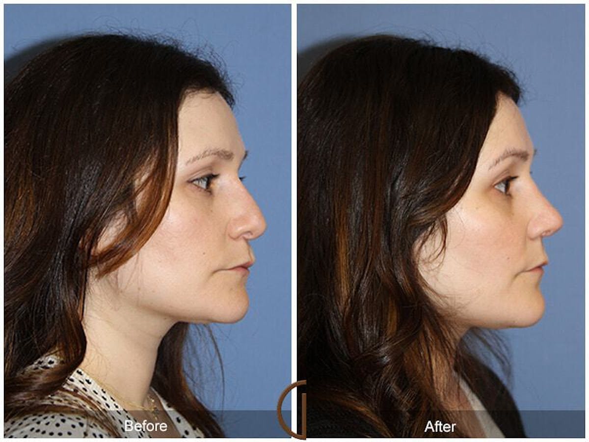 Female Rhinoplasty Before & After Gallery - Patient 302921 - Image 3