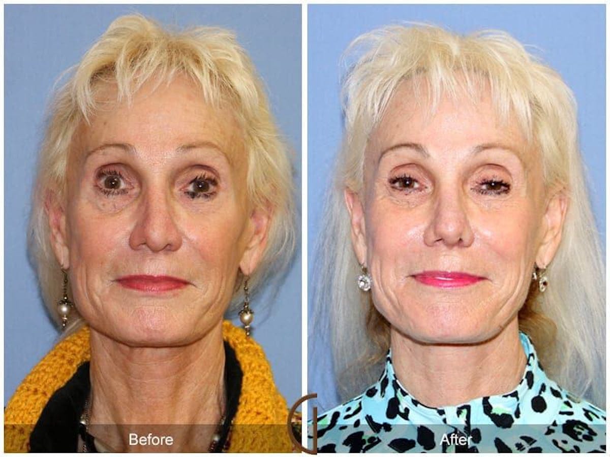 Revision Rhinoplasty Before & After Gallery - Patient 342452 - Image 2