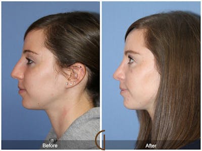 Female Rhinoplasty Before & After Gallery - Patient 268839 - Image 1