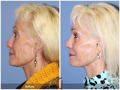 Revision Rhinoplasty Before & After Gallery - Patient 342452 - Image 1