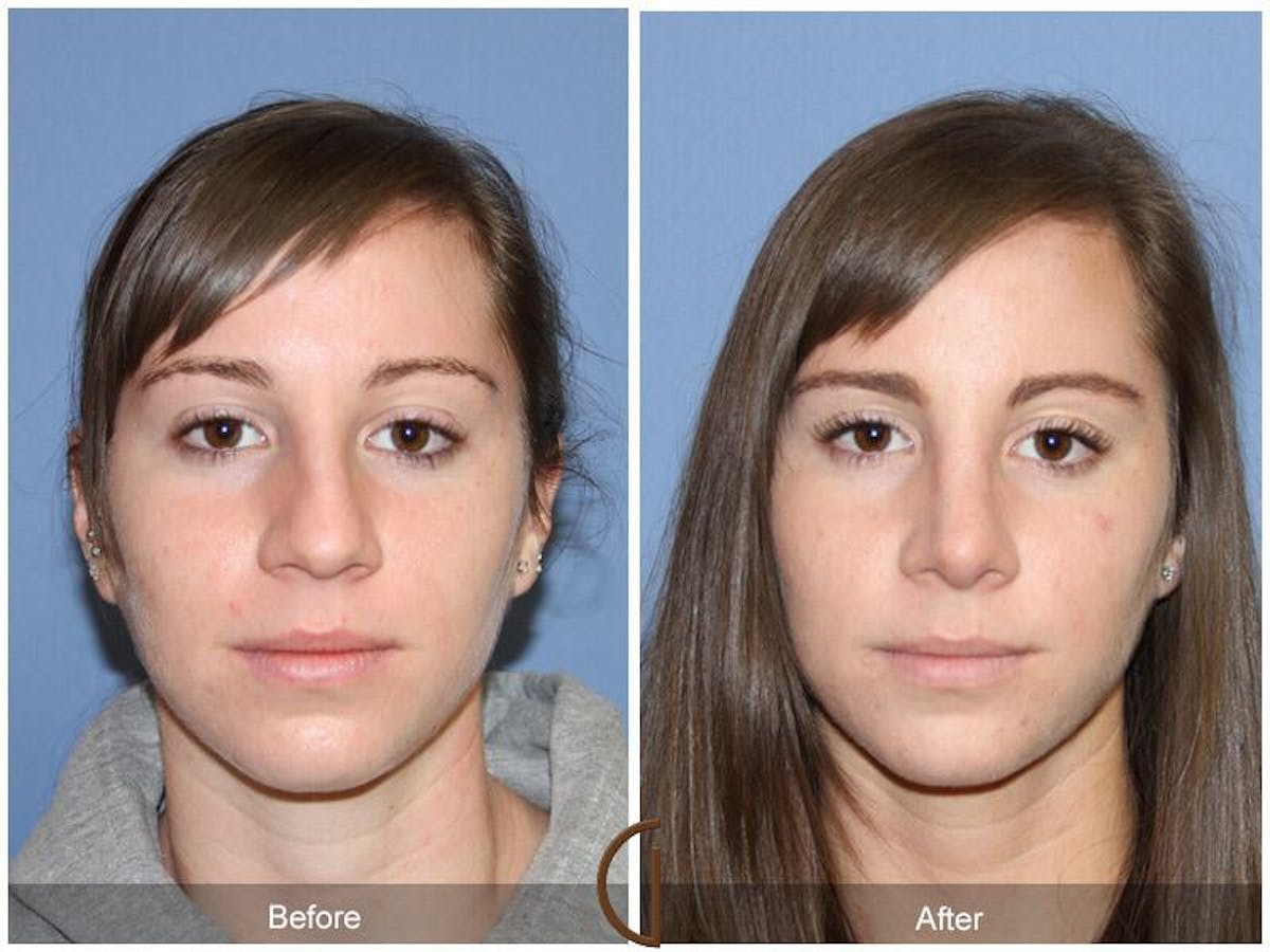 Female Rhinoplasty Before & After Gallery - Patient 268839 - Image 2