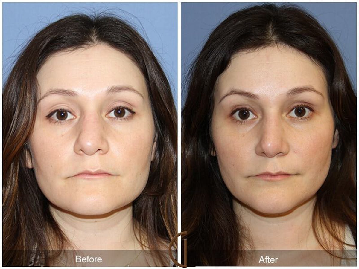 Female Rhinoplasty Before & After Gallery - Patient 302921 - Image 2