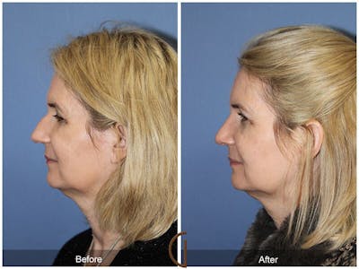 Female Rhinoplasty Before & After Gallery - Patient 420549 - Image 1