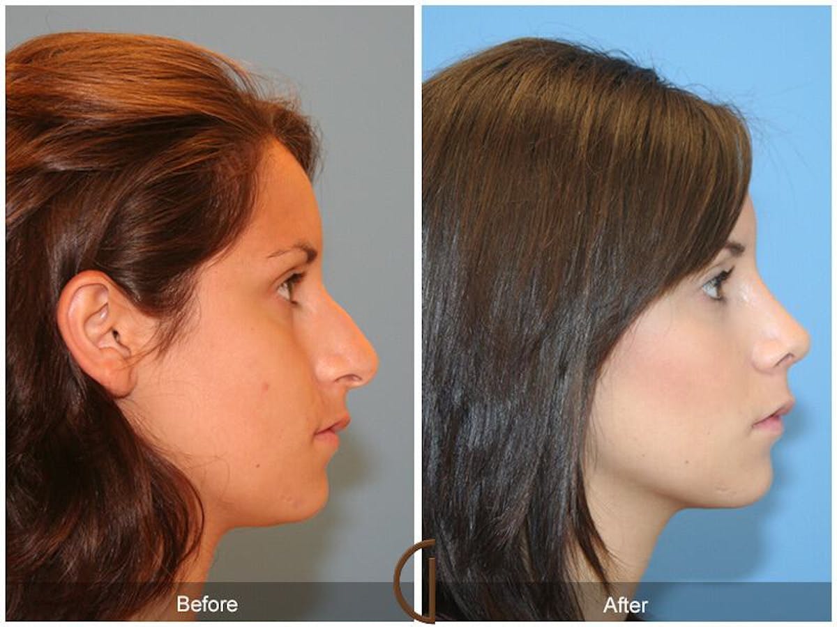 Female Rhinoplasty Before & After Gallery - Patient 113568 - Image 3