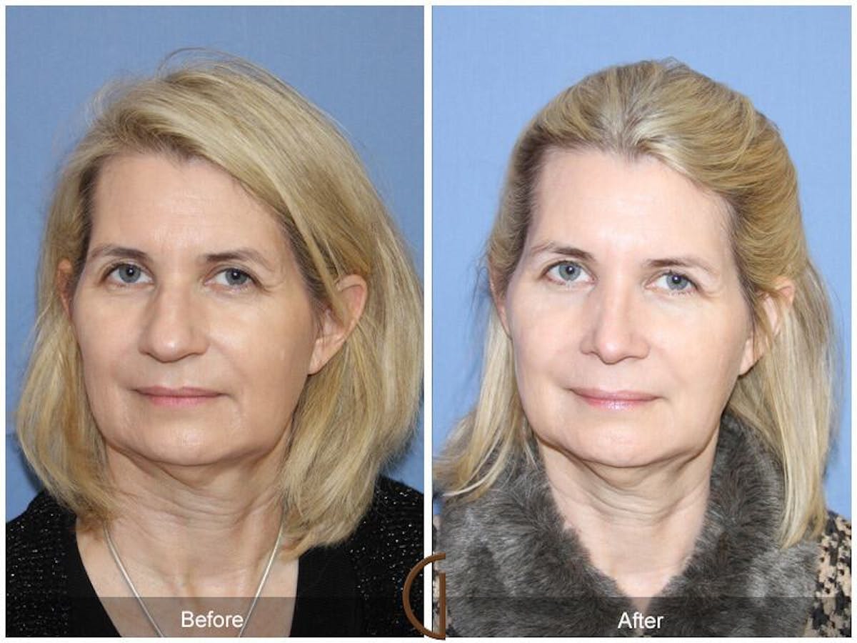 Female Rhinoplasty Before & After Gallery - Patient 420549 - Image 2