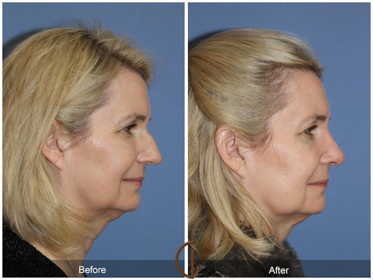 Female Rhinoplasty Before & After Gallery - Patient 420549 - Image 3