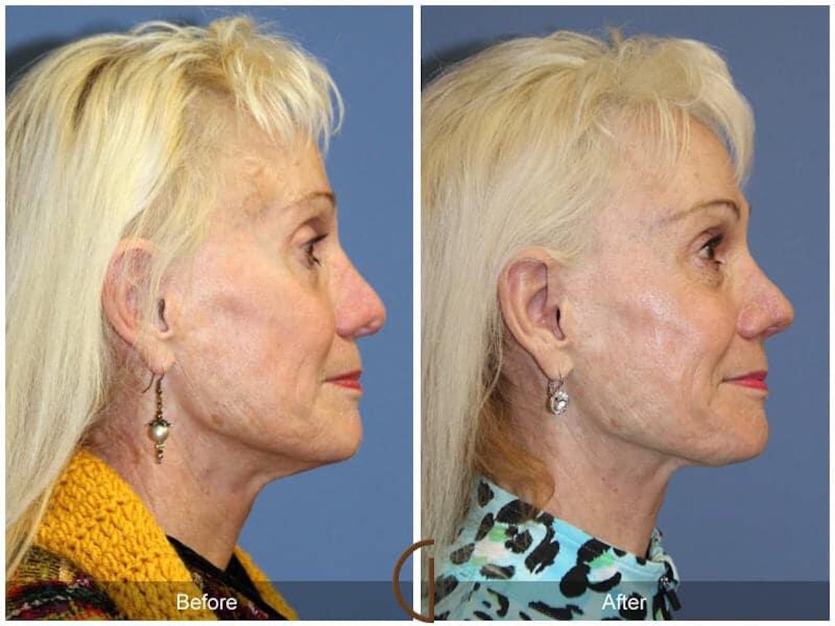 Revision Rhinoplasty Before & After Gallery - Patient 342452 - Image 3