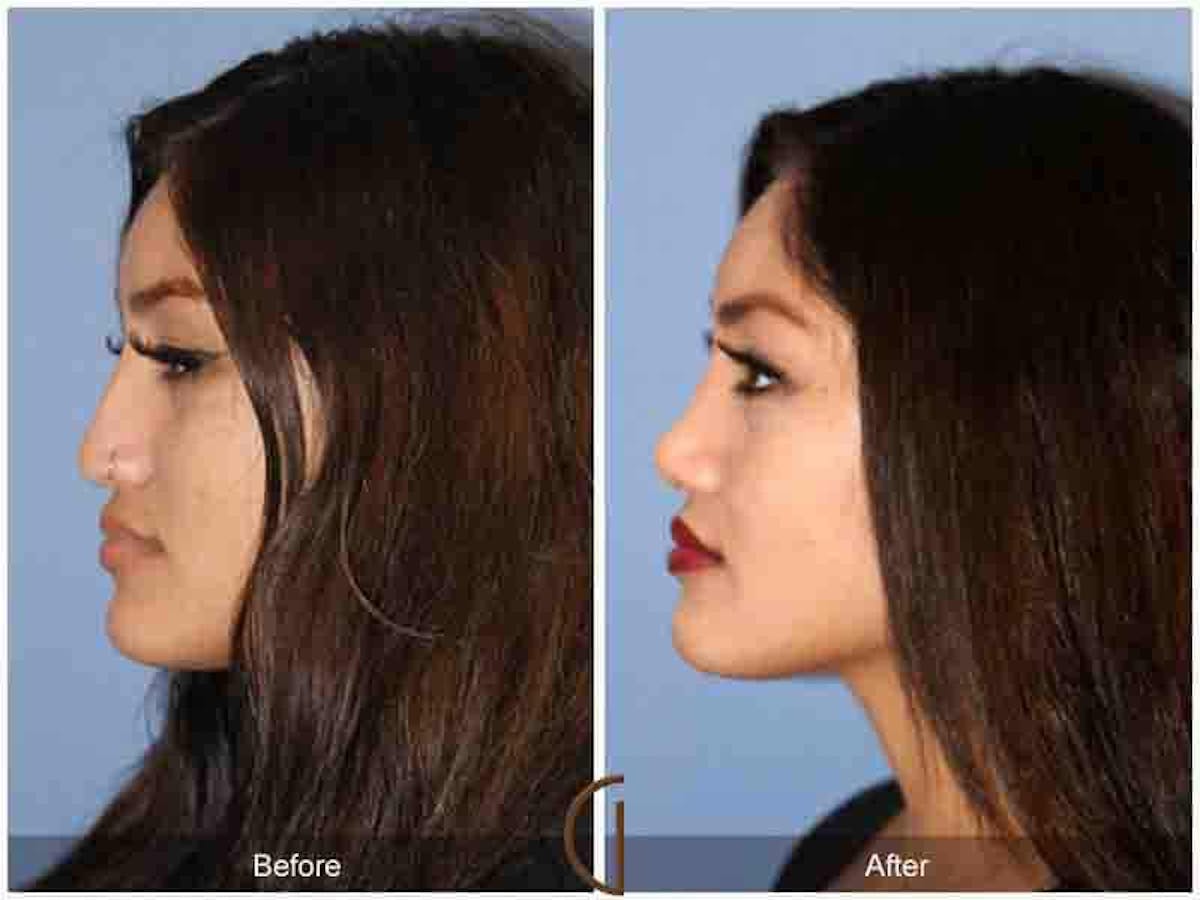 Ethnic Rhinoplasty Before & After Gallery - Patient 205177 - Image 1