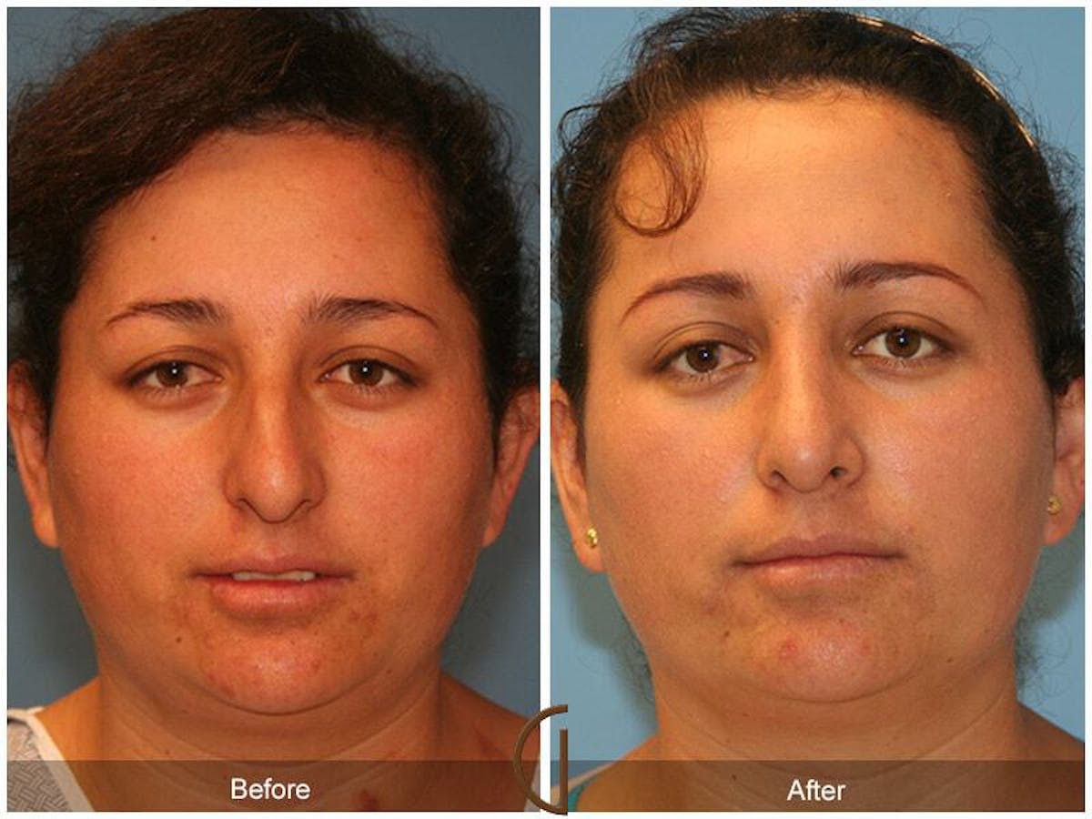 Ethnic Rhinoplasty Before & After Gallery - Patient 285736 - Image 2