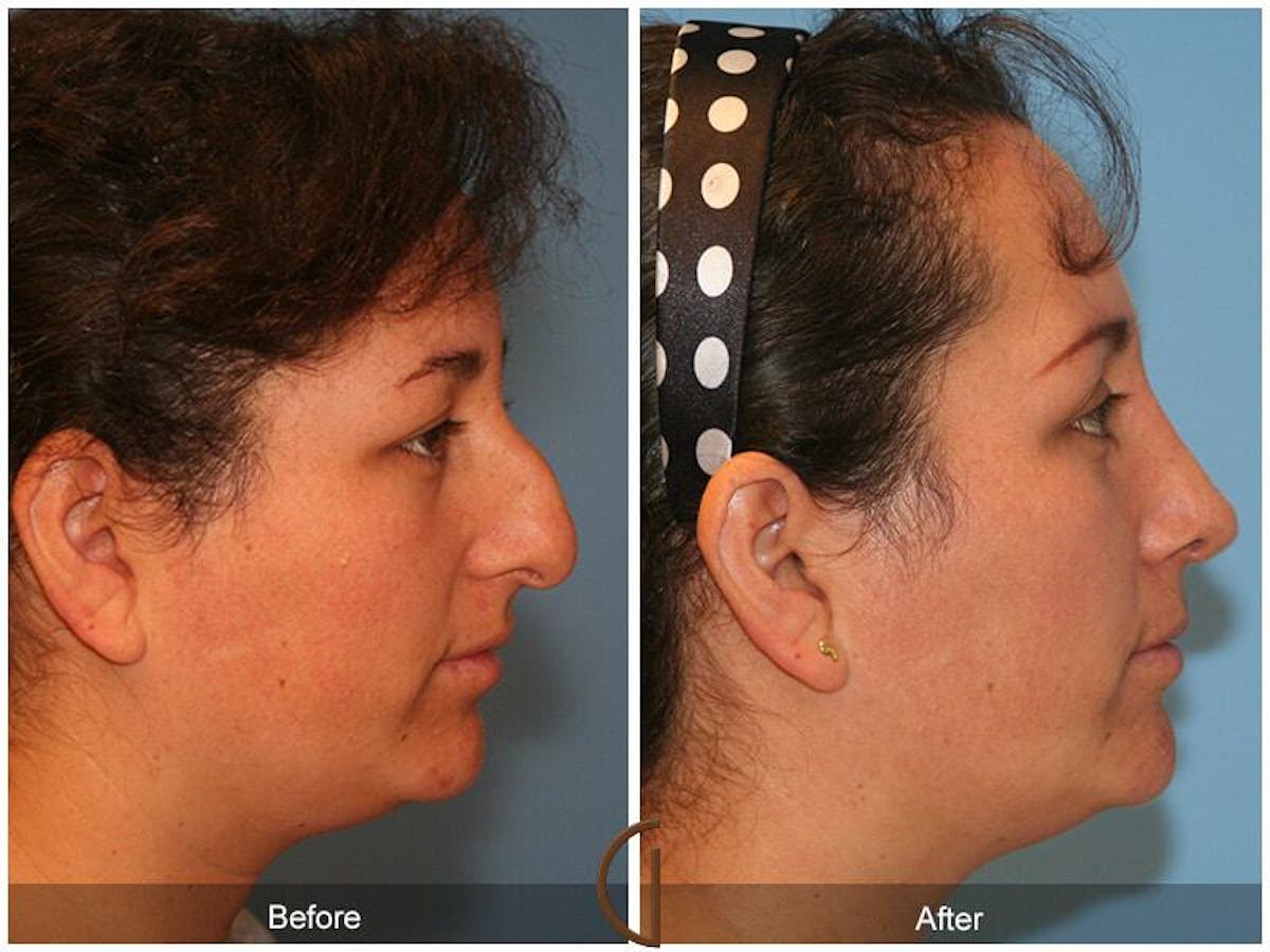 Ethnic Rhinoplasty Before & After Gallery - Patient 285736 - Image 3