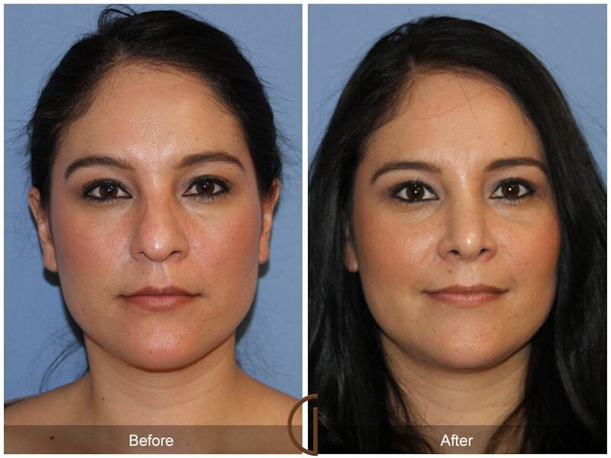 Female Rhinoplasty Before & After Gallery - Patient 516911 - Image 2