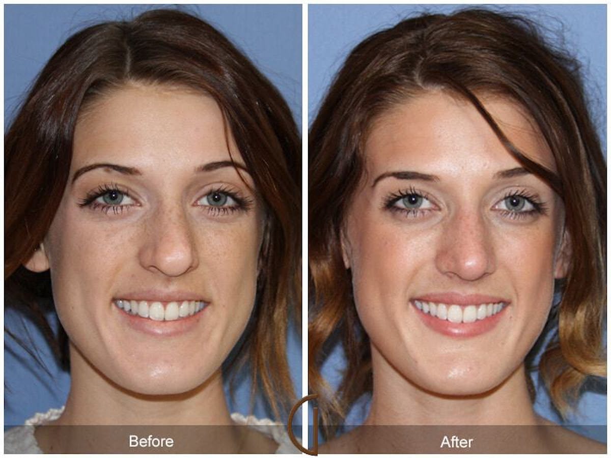 Female Rhinoplasty Before & After Gallery - Patient 180016 - Image 2