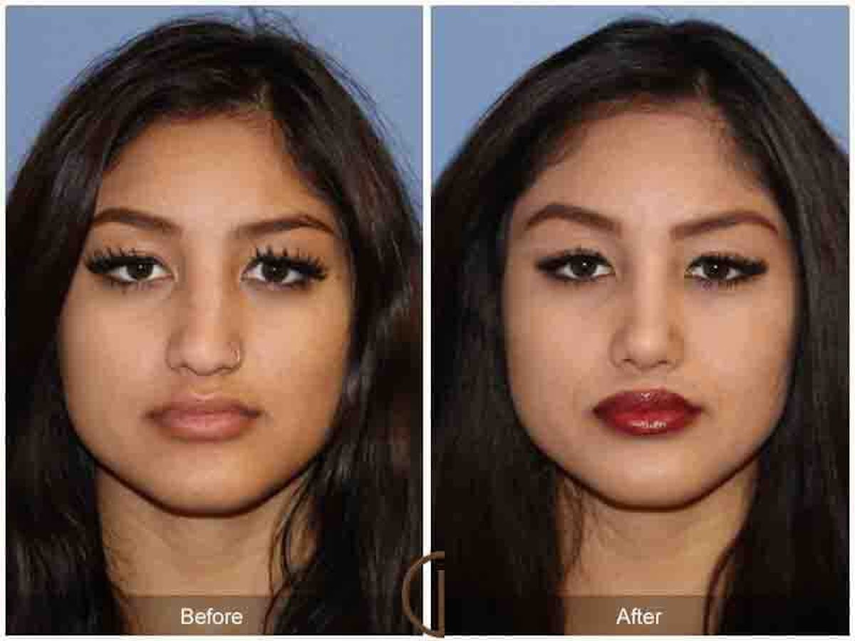 Ethnic Rhinoplasty Before & After Gallery - Patient 205177 - Image 2
