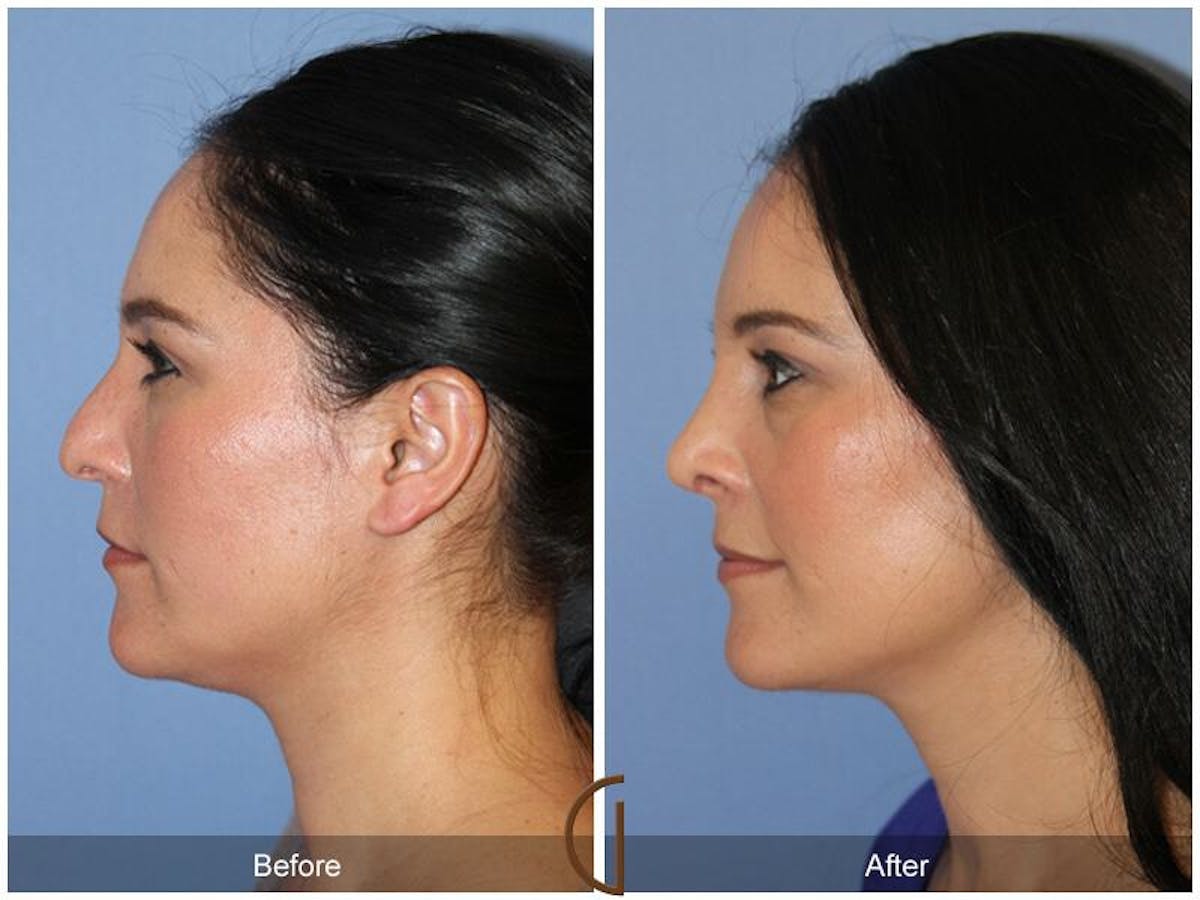 Female Rhinoplasty Before & After Gallery - Patient 516911 - Image 1