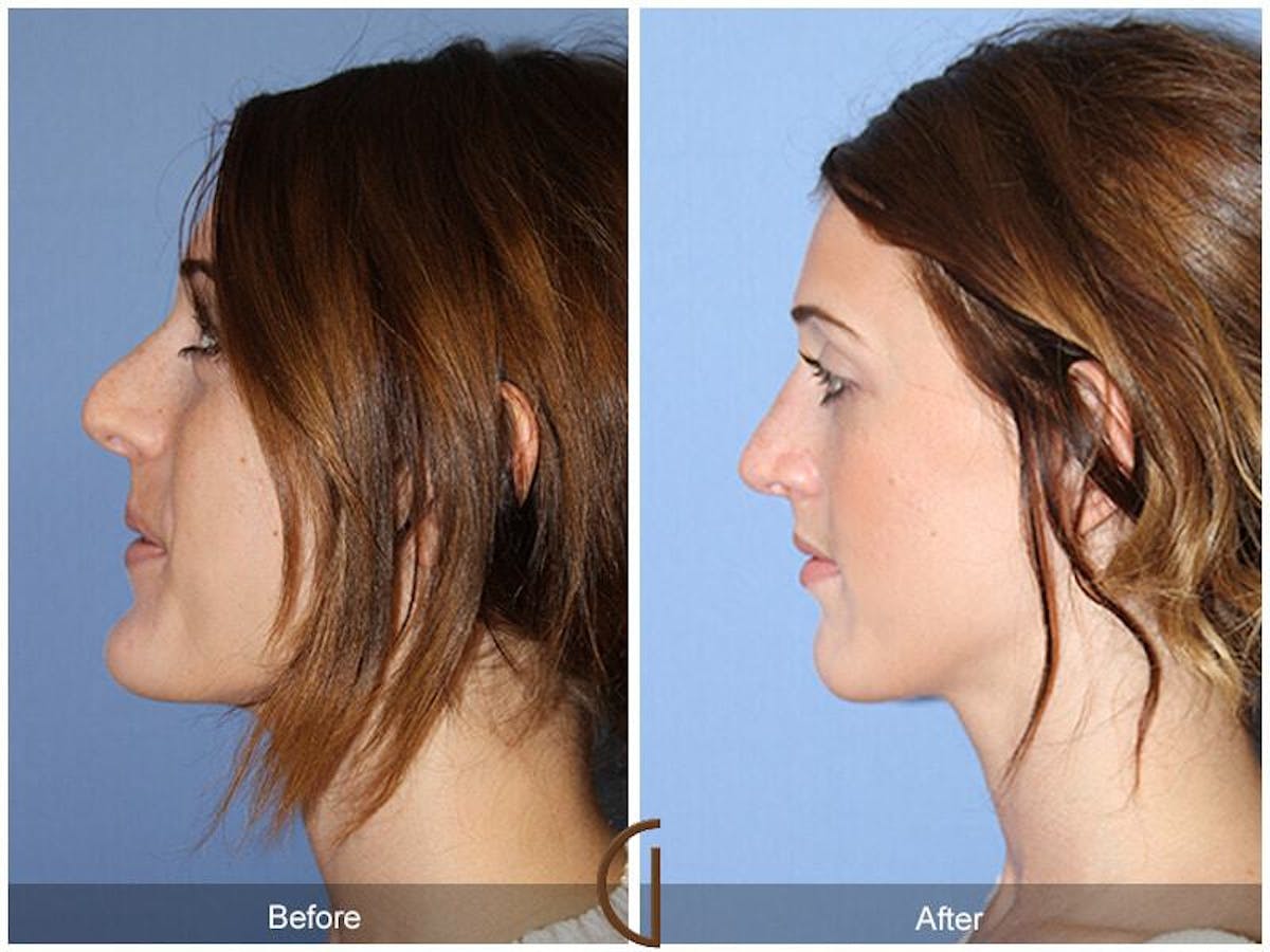 Female Rhinoplasty Before & After Gallery - Patient 180016 - Image 1