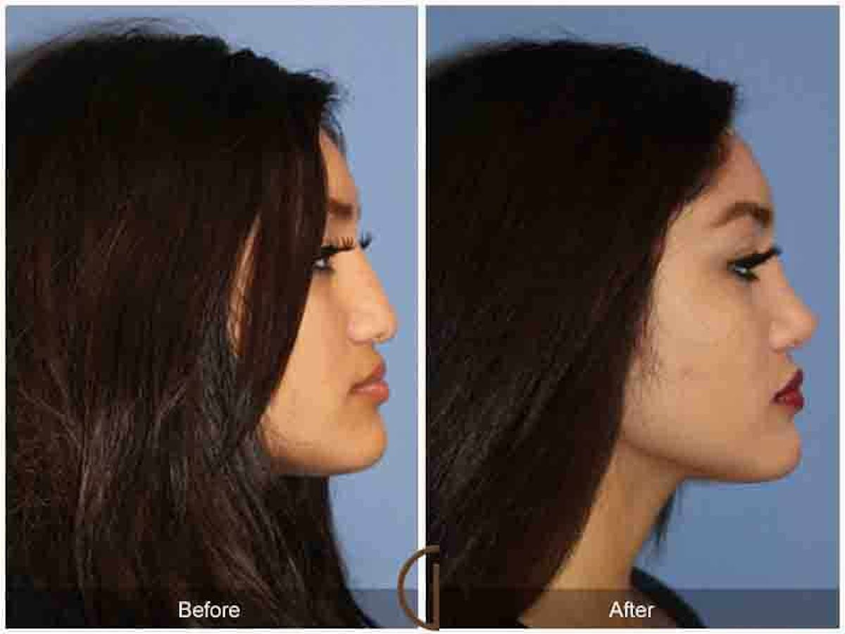 Ethnic Rhinoplasty Before & After Gallery - Patient 205177 - Image 3