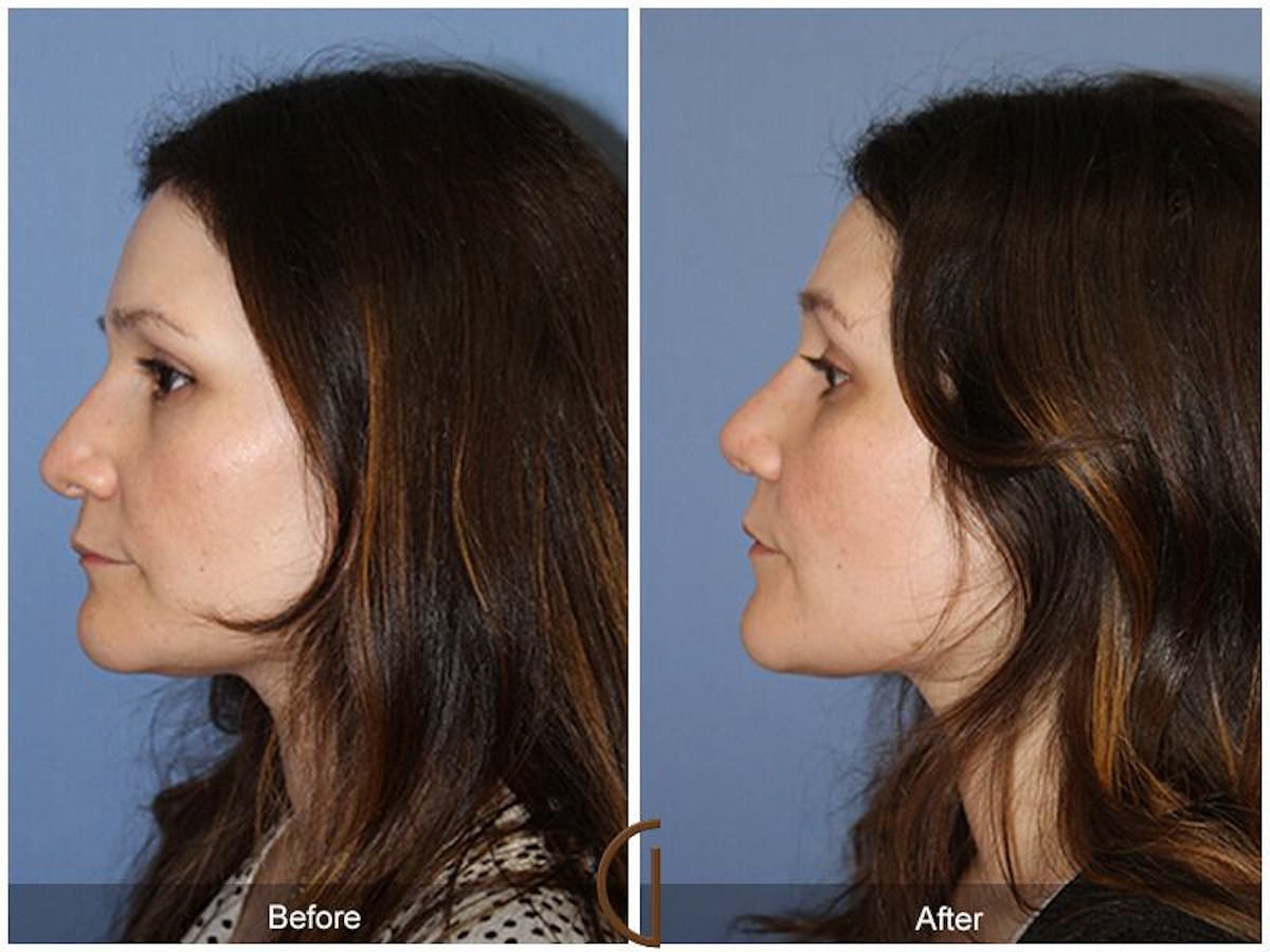 Revision Rhinoplasty Before & After Gallery - Patient 961780 - Image 1