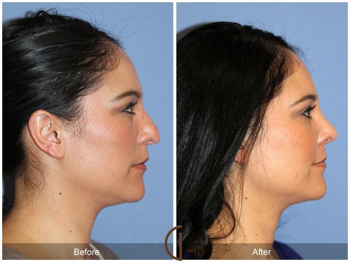 Female Rhinoplasty Before & After Gallery - Patient 516911 - Image 3