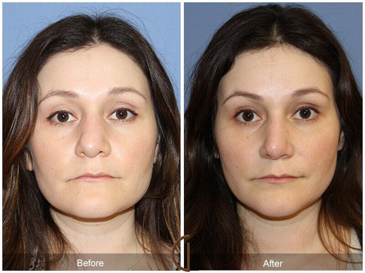 Revision Rhinoplasty Before & After Gallery - Patient 961780 - Image 2