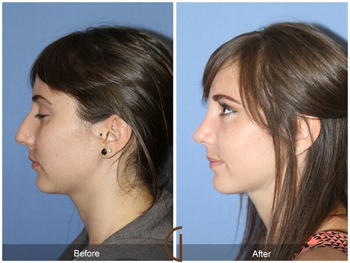 Female Rhinoplasty Before & After Gallery - Patient 298285 - Image 1