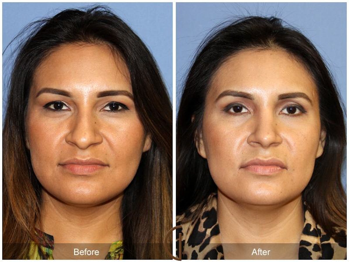 Female Rhinoplasty Before & After Gallery - Patient 197646 - Image 2